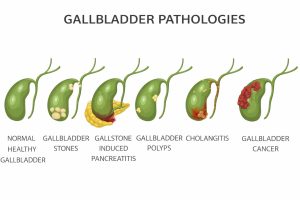 Hidden Signs of Gallbladder Disease