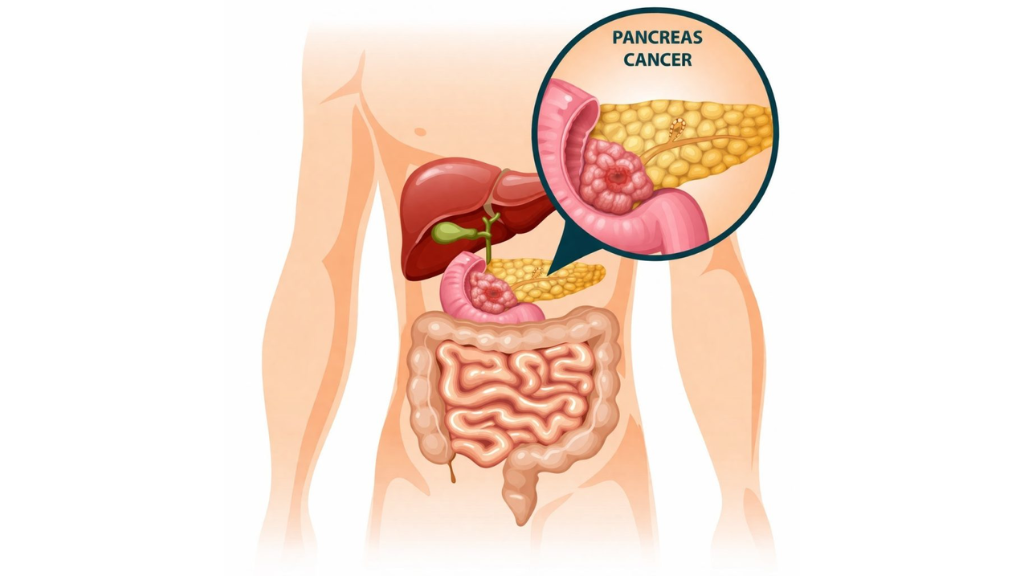 Pancreatic tumor